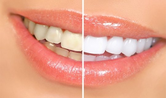 Dişlərinizi ağartmağın 5 yolu