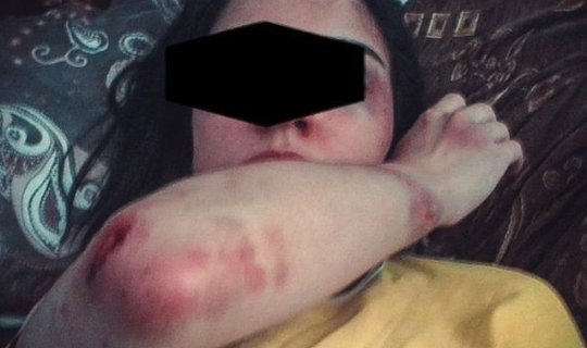 Hamilə sevgilisini ütü ilə yandıran kişi həbs edildi