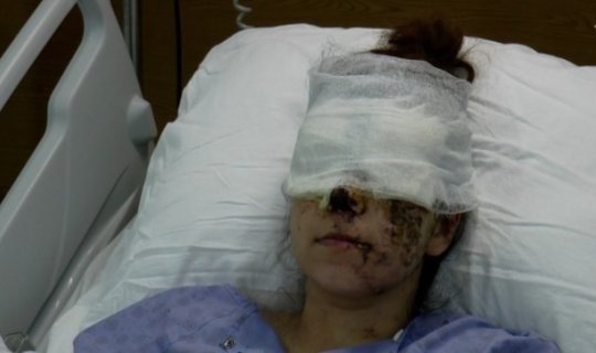 Ermənilərin Gəncə terroru iki uşaq anasını görmə qabiliyyətindən məhrum etdi - FOTO/VİDEO