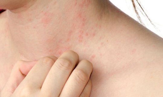 Hansı növ allergiyası olan xəstələr peyvənd vurdurmayacaq? – RƏSMİ AÇIQLAMA