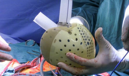 Dünyada ilk dəfə süni ürək transplantasiyası reallaşdırılıb