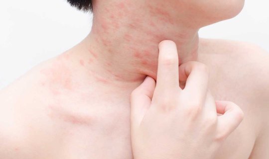 Allergiyalarla bağlı əks göstəriş sertifikatı üçün bu halda müraciət oluna bilər