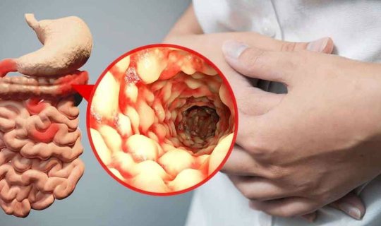 Bağırsaqları yeyən “Kron” xəstəliyinin 9 əlamətixa0– Azərbaycanda çox rast gəlinir