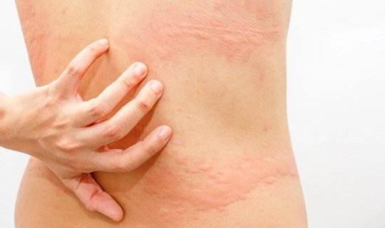 Əgər bədəndə ağrılar kəsmirsə, bu adi herpes ola bilərxa0– İnfarktla səhv salınan xəstəlik
