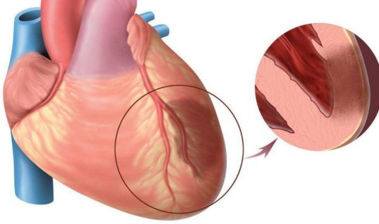 Ayaqüstü keçirilən infarkt - Tromb damarda qopanda nə baş verir?