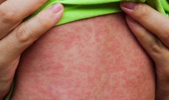 Uşağın bədənindəki səpkilərə görə xəstəliyini tanı - Pediatrdan açıqlama