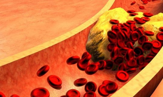 Damarları xolesterindən təmizləmək üçün 5 TƏBİİ ÜSUL