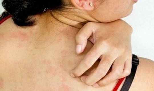 Kürək nahiyyəsində səpgilər, qızartı və ləkələrin səbəbi