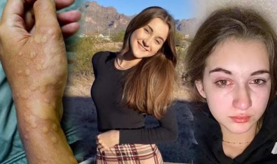 15 yaşlı qız nadir xəstəlikdən əziyyət çəkir: nə su içə bilirəm, nə də ağlaya - FOTO