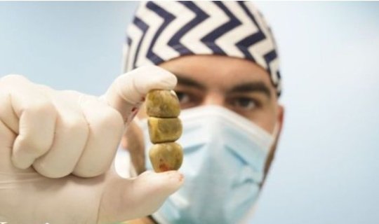 Öd xəstəliyinin cavanlaşmasına səbəb “fast food”lar, həyat tərzinin dəyişməsi və hərəkətsizlikdir - FOTO