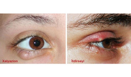 İtdirsəyi və xalyazion necə müalicə edilir?