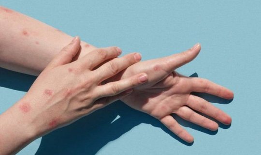 Meymunçiçəyinin yeni fəsadları açıqlandı
