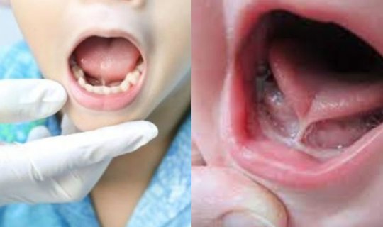 Uşaqlarda dilaltı pərdə kəsilməlidir, yoxsa yox?