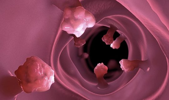 Bağırsaqlarda polip və adenomalar təhlükəlidirmi?