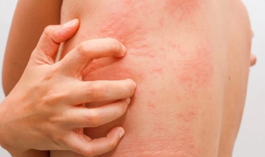 Allergiya xəstələrinə XƏBƏRDARLIQ: Testlərdən keçin