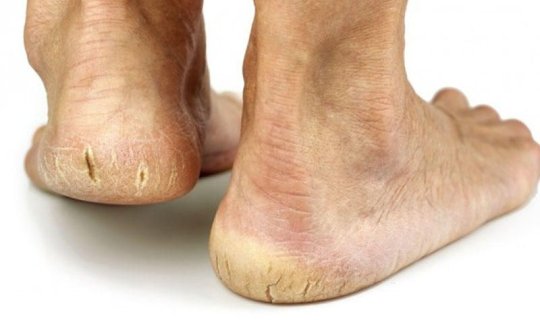 Dabanda çatları olanlar – Bu vitaminləri qəbul etsin