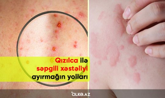 Qızılca ilə səpgili xəstəliyi ayırmağın yolları - Peyvəndlə bağlı suallara CAVAB