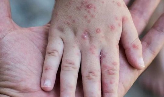 ÜST Avropada qızılca epidemiyasının səbəbini açıqladı