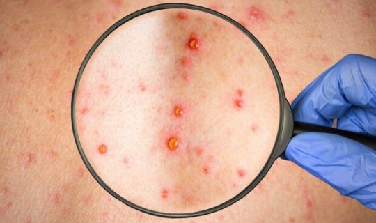 Qızılcaya təkrar yoluxmaq mümkündürmü? – ARAŞDIRMA VİDEO