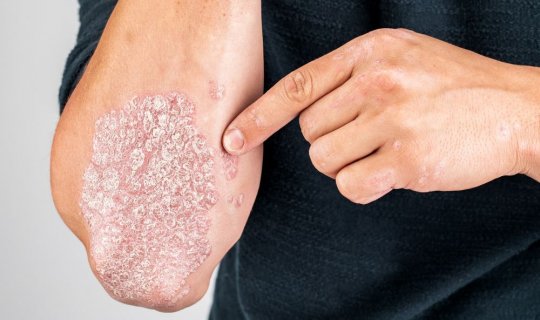 Alimlər psoriazın potensial səbəbini tapdılar