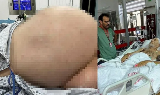 Qarın ağrısı şikayəti ilə xəstəxanaya getdi, 26 kilo... - FOTO