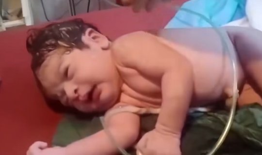 Ürəyi dayanan körpəni həkimlər həyata qaytardı - Video