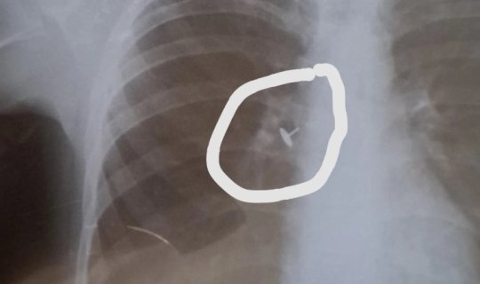 Azərbaycanda həkim yad cisim udan uşağa soyuqlama əleyhinə müalicə yazdı