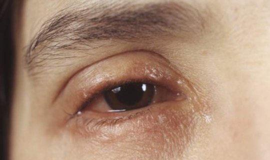 "Bahar katarı görmə itkisinə səbəb olur" - Həkim