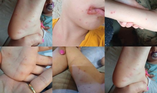 Uşağınızda koksaki varsa, bunları edin - Həkimdən xəbərdarlıq