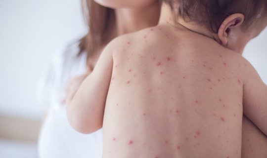 Azərbaycanda qızılca xəstəliyi ilə bağlı son vəziyyət açıqlandı - RƏSMİ
