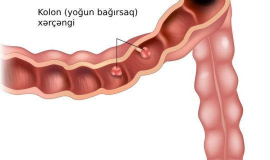 Bu qidalar bağırsaq xərçənginə səbəb olur - ADLAR
