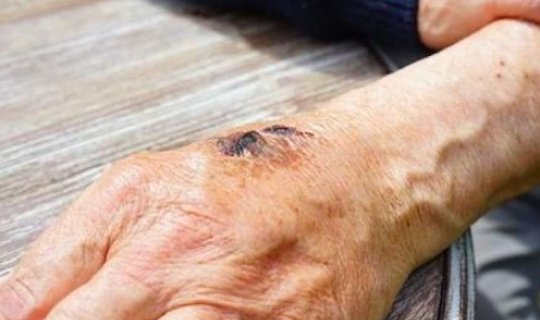 Azərbaycanda qarayaraya yoluxanların sayı artıb