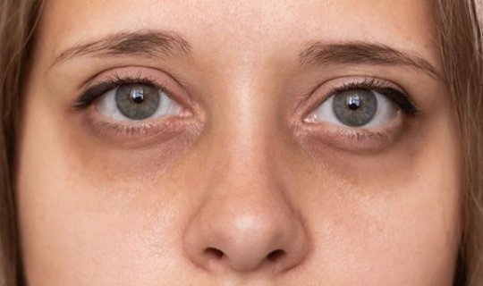 Gözaltı göyərmə və qaraltılar &ndash; Hansı xəstəlikdən xəbər verir?