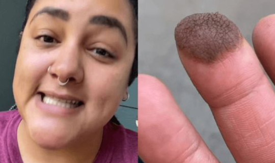 Dəri transplantasiyası olan qızın barmağından tüklər çıxdı - FOTO