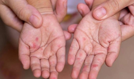 Bu ölkədə qızılca epidemiyası böyüyür: Ölənlərin sayı 712-yə çatdı
