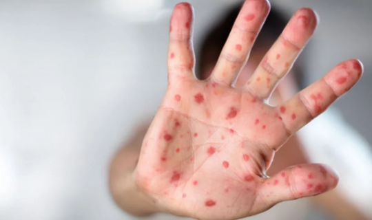 Qızılca və suçiçəyi ilə bağlı epidemioloji vəziyyət açıqlandı