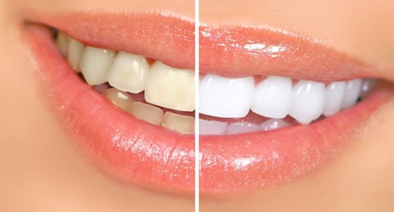 Dişlərinizi ağartmağın 5 yolu