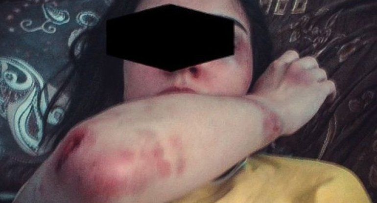 Hamilə sevgilisini ütü ilə yandıran kişi həbs edildi