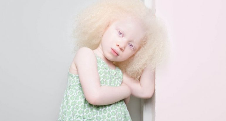 Ən nadir insanlar - albinoslar