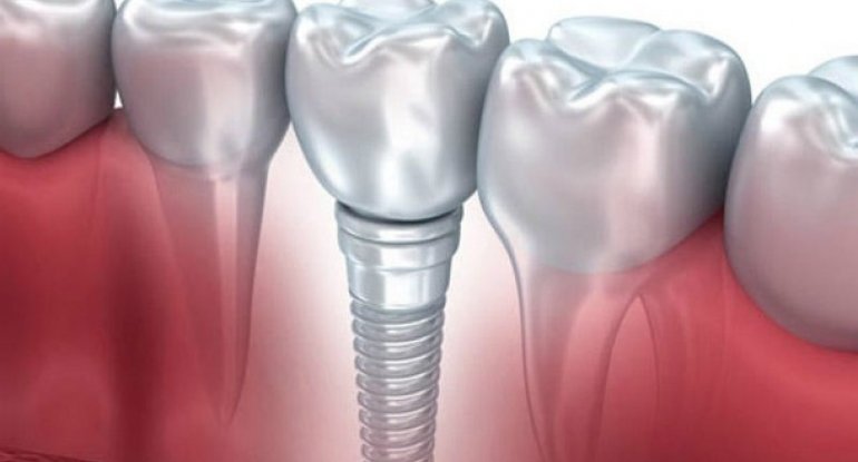 Diş implantı xərçəng yaradır?