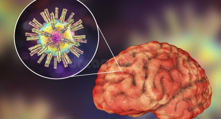 Koronavirusun əsas fəsadları açıqlandı