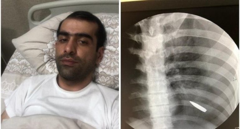 Bərdə indiyə qədər gördüklərimin ən qorxulusu idi: Cəbhədə könüllü xidmət etmiş həkimlə MÜSAHİBƏ