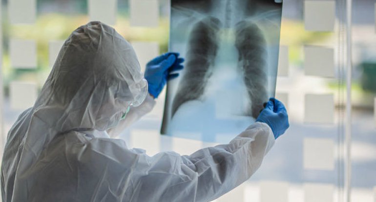 Buzlu şüşə diaqnozu qoyulan koronavirus xəstələri nə etməlidirlər? - Həkimdən AÇIQLAMA