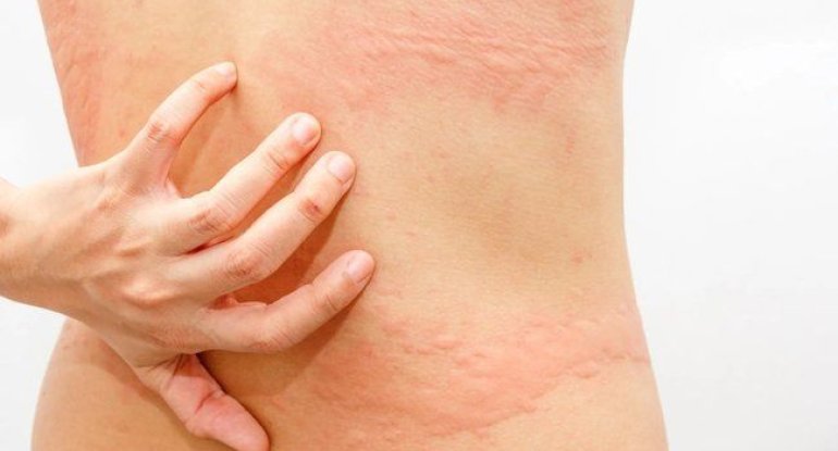 Əgər bədəndə ağrılar kəsmirsə, bu adi herpes ola bilərxa0– İnfarktla səhv salınan xəstəlik