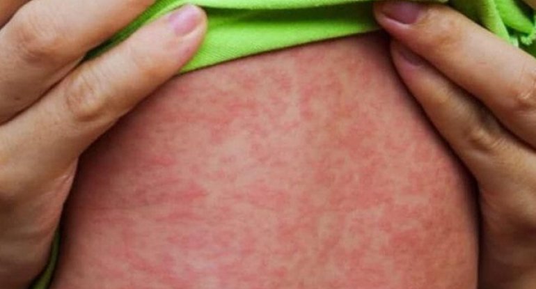 Uşağın bədənindəki səpkilərə görə xəstəliyini tanı - Pediatrdan açıqlama