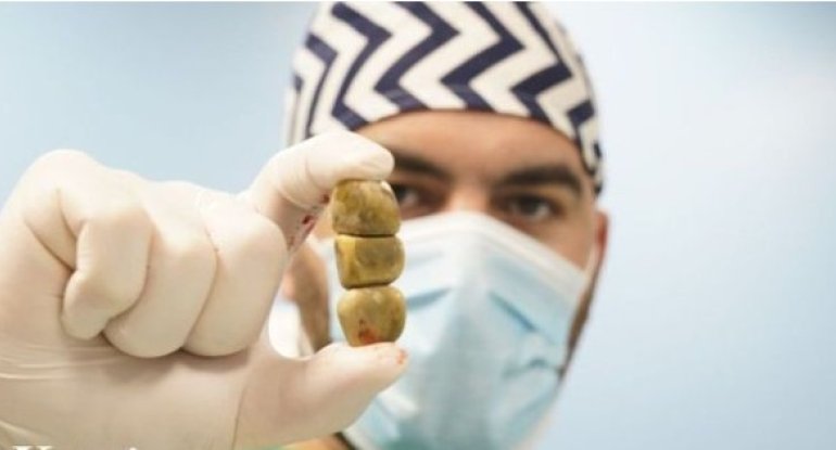 Öd xəstəliyinin cavanlaşmasına səbəb “fast food”lar, həyat tərzinin dəyişməsi və hərəkətsizlikdir - FOTO