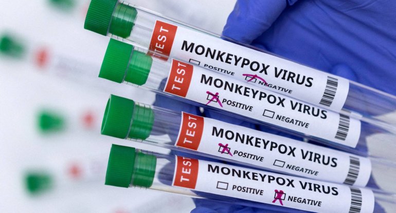 Azərbaycana meymunçiçəyi test dəstləri gətirildi