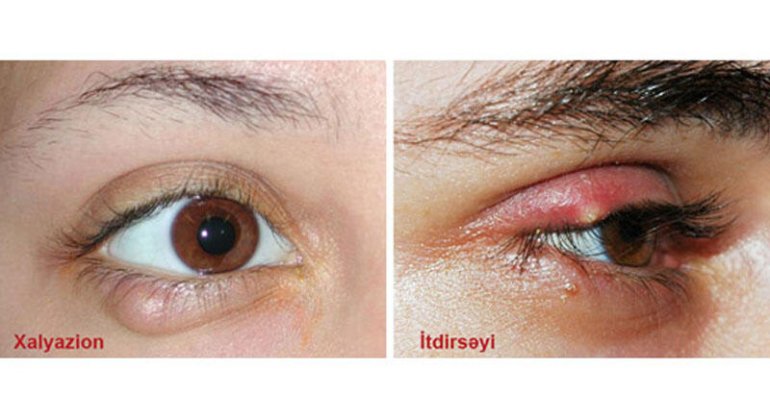 İtdirsəyi və xalyazion necə müalicə edilir?