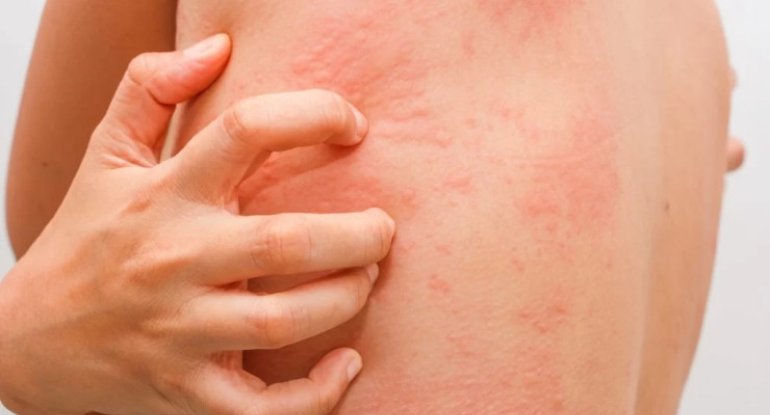 Allergiya xəstələrinə XƏBƏRDARLIQ: Testlərdən keçin