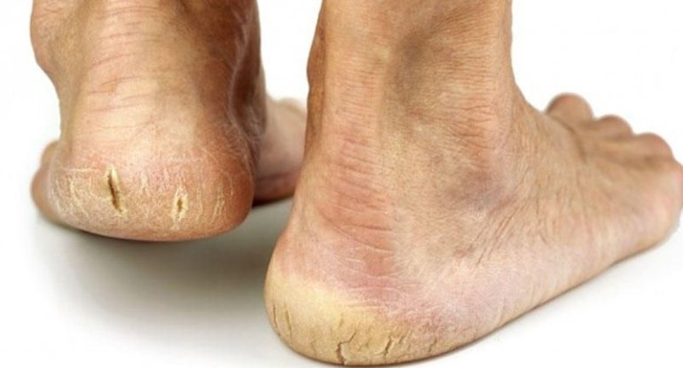 Dabanda çatları olanlar – Bu vitaminləri qəbul etsin